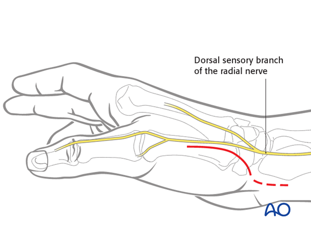 The disadvantage of this incision is the risk of scar formation across the wrist crease.