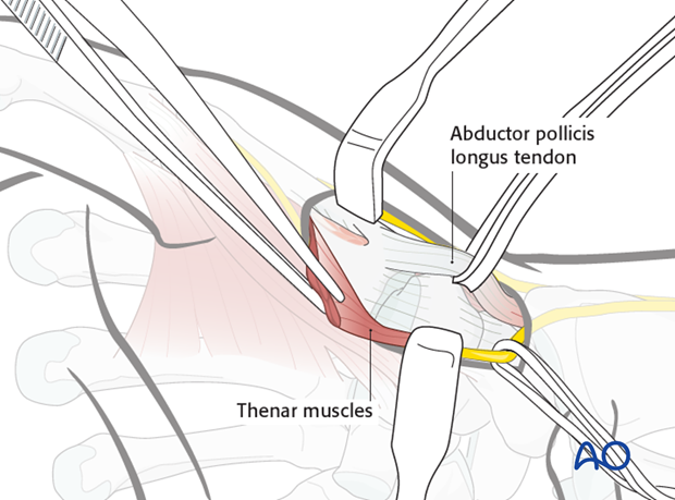 After retracting these structures, the thenar muscles come into view. They are then detached from their origins at the base ...