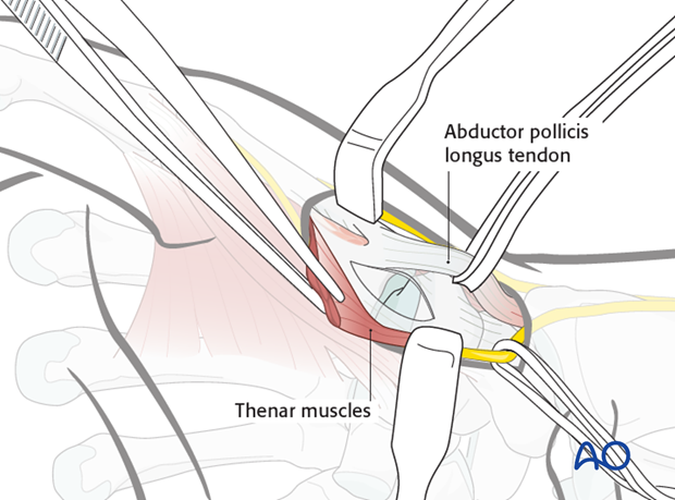 Perform a transverse or longitudinal capsulotomy in order to expose the joint.