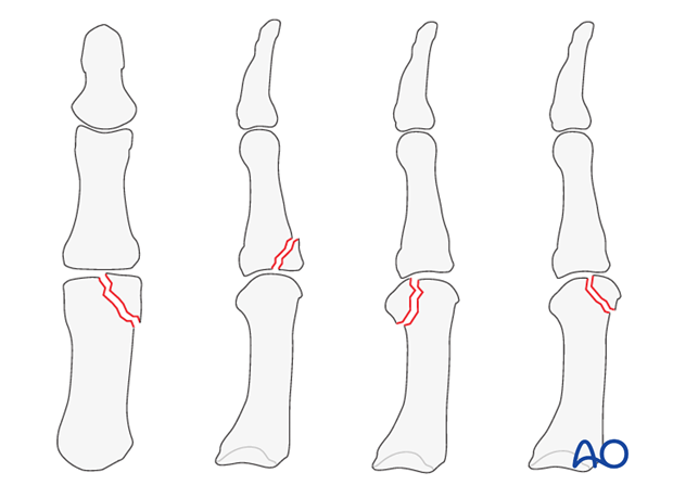 This approach is indicated for intraarticular, or periarticular, fractures of the metacarpophalangeal (MCP) joint of the thumb.