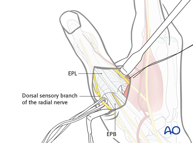 Elevate the skin and fine subcutaneous tissue as a single layer, by blunt dissection, and expose the tendons of extensor ...