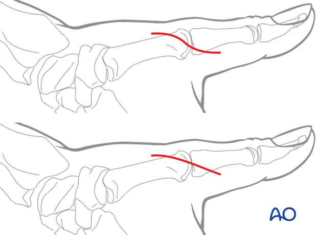 Dorsoulnar approach to the MCP joint of the thumb