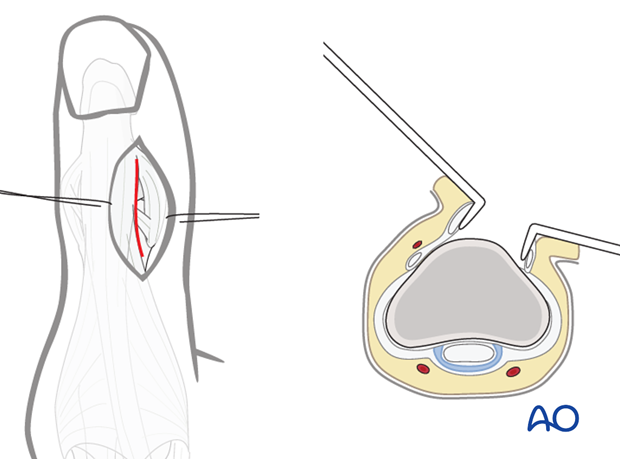 A straight dorsoradial, or dorsoulnar, skin incision will allow retraction of the distal tendon of EPL without having to ...