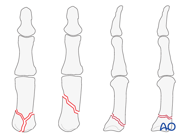 This approach is indicated for extraarticular fractures of the first metacarpal, and for periarticular fractures of the ...