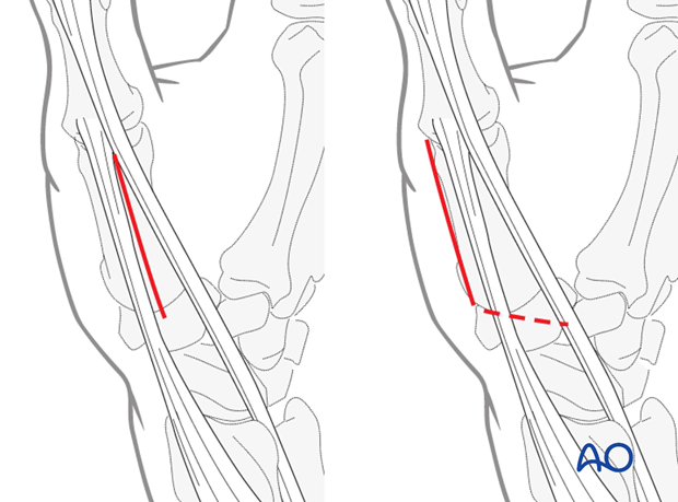 This approach is indicated for extraarticular fractures of the first metacarpal, and for periarticular fractures of the ...