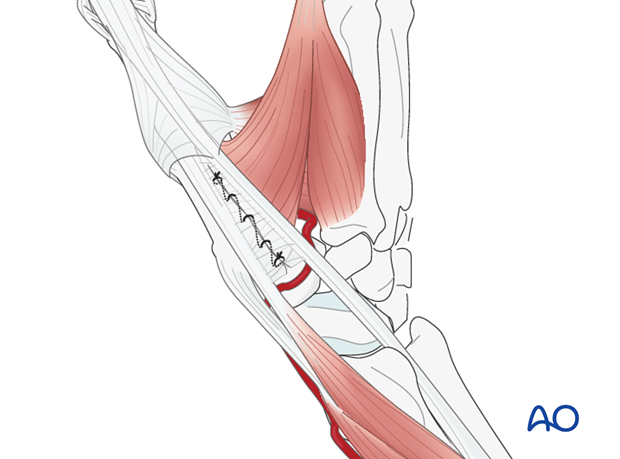 The fascia between the EPB and EPL tendons can be repaired either with a running suture or with multiple fine mattress sutures.