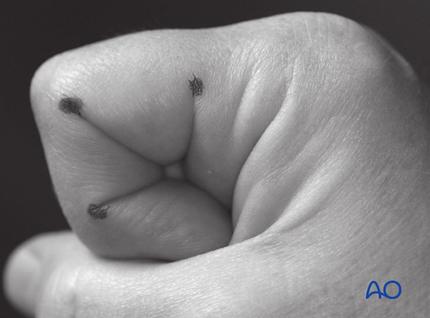 To plan the line of the incision, fully flex the finger as shown and mark the dorsal ends of the flexor creases with dots.