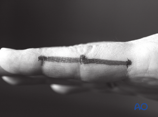 Extend the finger and connect the dots in a line. The resulting line is safe for a midaxial skin incision.