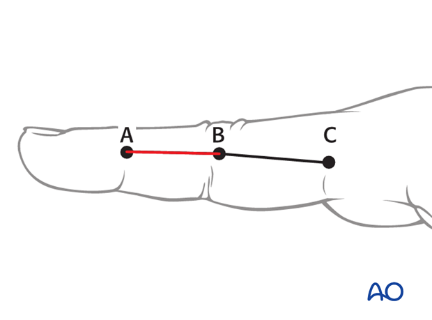 Blunt dissection extends the approach through the thin subcutaneous tissue, taking care to identify and protect the dorsal ...