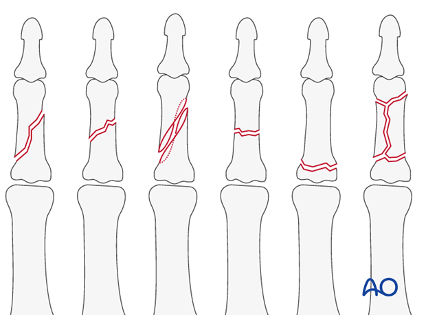 The dorsal approach is indicated for oblique, spiral, comminuted, or transverse fractures of the diaphysis, or metaphysis ...