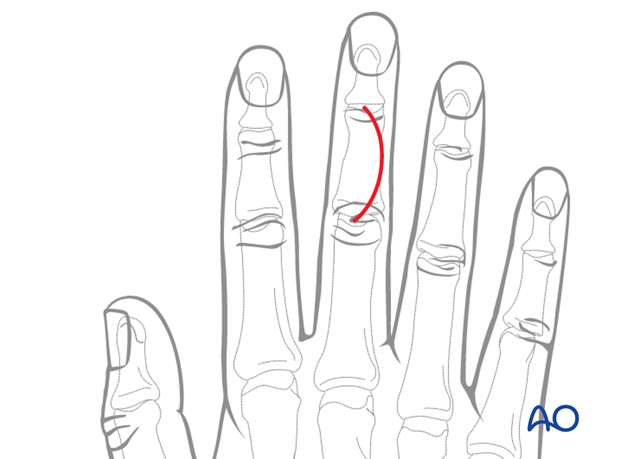 The convexity of the incision is planned so that the scar does not involve the radial border of the index, or the ulnar ...