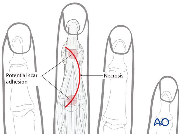 The advantage of the curved incision is that the scarring of skin and tendon is not in line. 