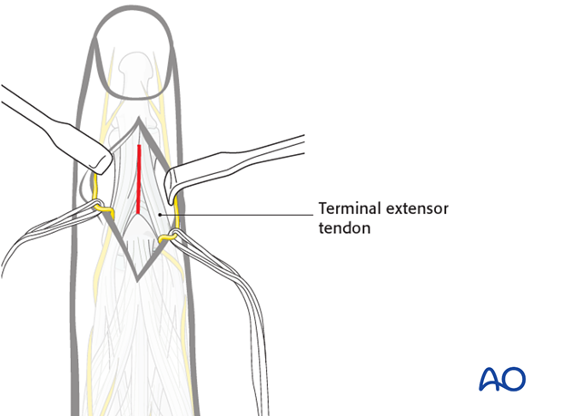 Make a longitudinal incision through both the terminal extensor tendon and its triangular ligament, taking care to preserve ...