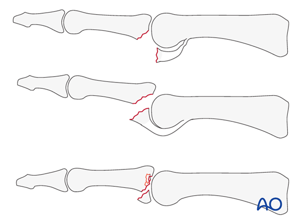 The palmar approach is indicated mainly for volar plate avulsion fractures of the base of the middle phalanx, ...