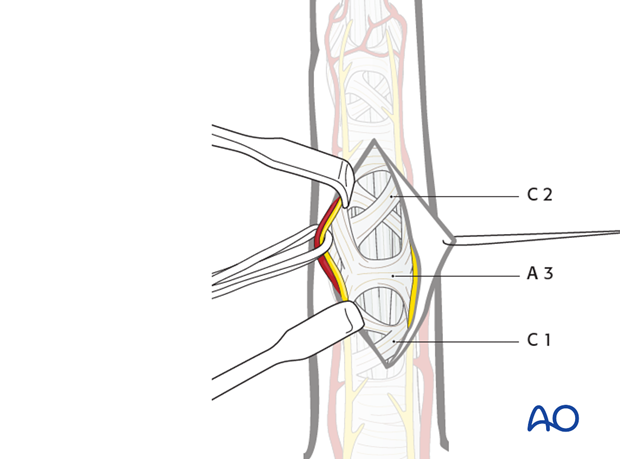 The angled skin flap is elevated by blunt dissection in the thin subcutaneous tissue, and the apex retracted using a fine ...