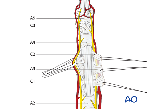 Incise the C1, A3, and C2 pulleys laterally, near their bony attachments, leaving enough (at least 2 mm) for later ...