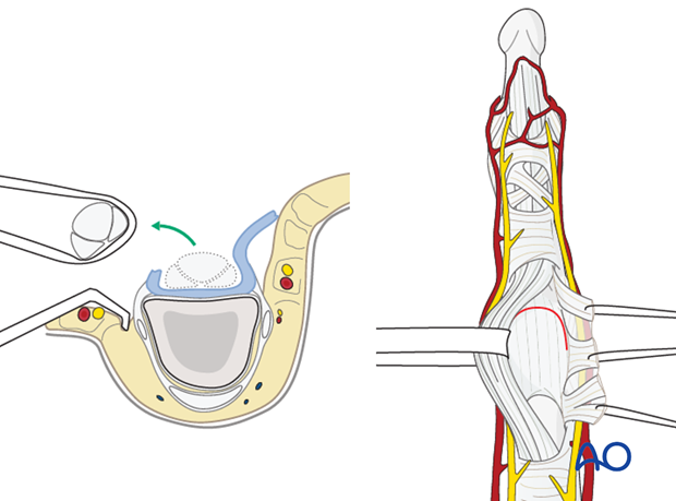 Retract the flexor tendons, using a latex loop (such as a Penrose drain).