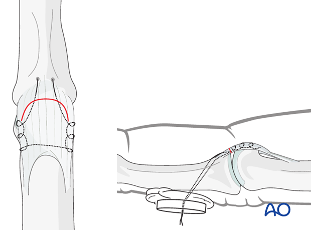 Reattach the volar plate and any small attached fracture fragment, using either a pullout suture, or at least two anchor ...