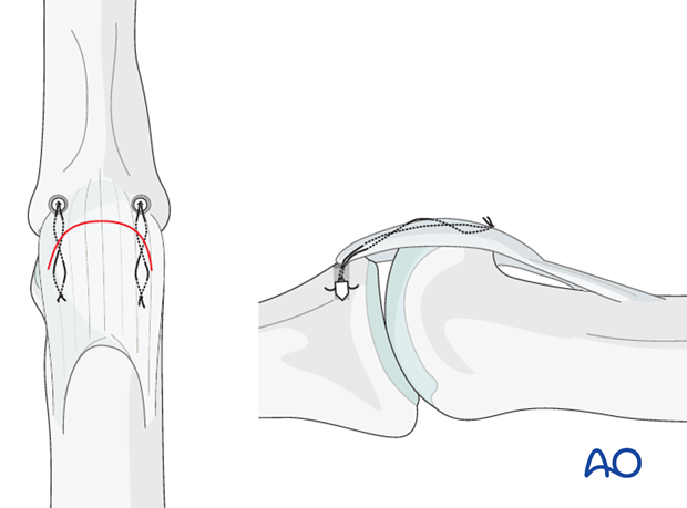 It is mandatory to repair the A3 pulley. If possible, also reattach the C1 and C2 pulleys.