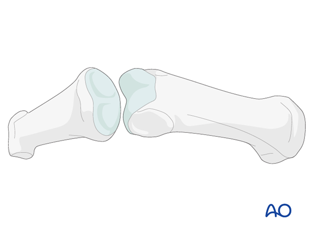 The heads of the proximal and middle phalanges each have two articular condyles that resemble a grooved trochlea, and ...