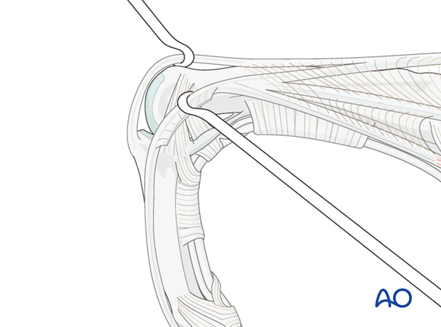 A further window can be created, firstly by flexing the PIP joint and developing the interval between the central and ...