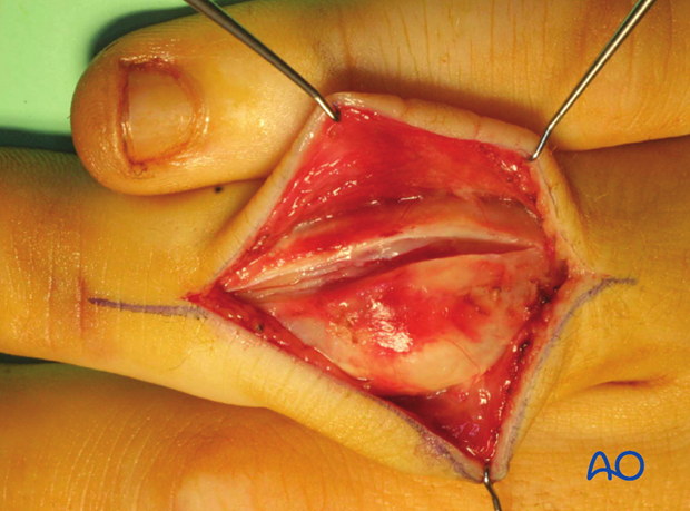 dorsal approaches to the pip joint