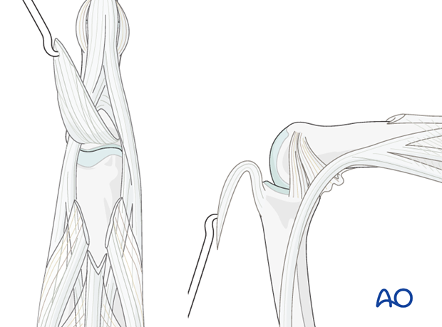 Raise the central extensor slip as a distally-based, V-shaped flap, leaving it attached to the base of the middle phalanx ...