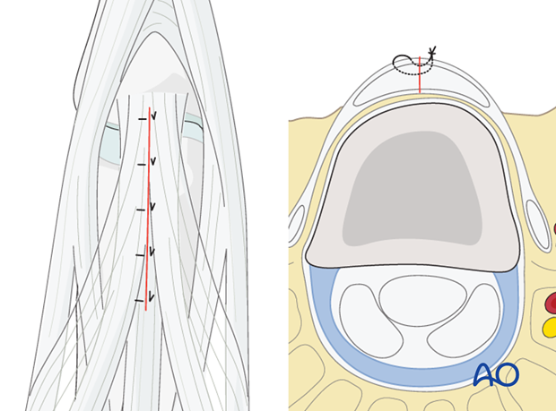 Regardless of the approach chosen, all tendon incisions need to be sutured prior to wound closure.