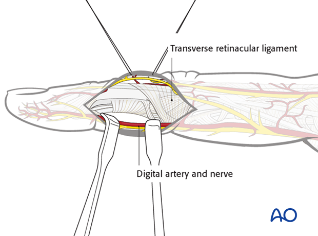 Elevate the thin subcutaneous tissues by blunt dissection. Identify and protect the digital vessels and nerve on the palmar ...