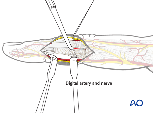 Divide the TRL, using a dental pick inserted between it and the collateral ligament, to avoid accidentally cutting the ...