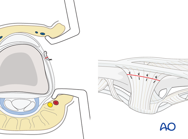 The TRL is repaired using multiple fine mattress sutures prior to skin closure.