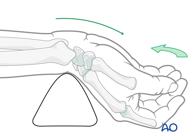 Hyperextending the wrist