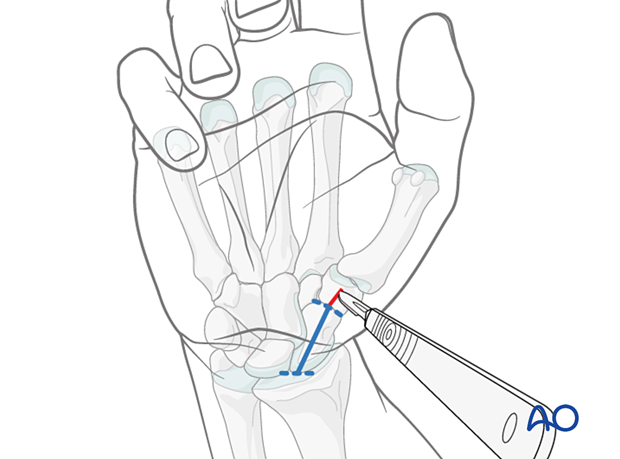 Making a stab incision during minimally invasive palmar approach to the scaphoid