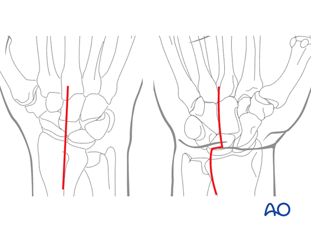 Dorsal and palmar skin incision for a combined approach to the carpus