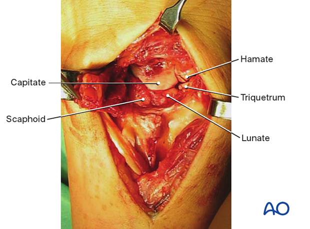 Intraoperative image showing the exposed midcarpal bones