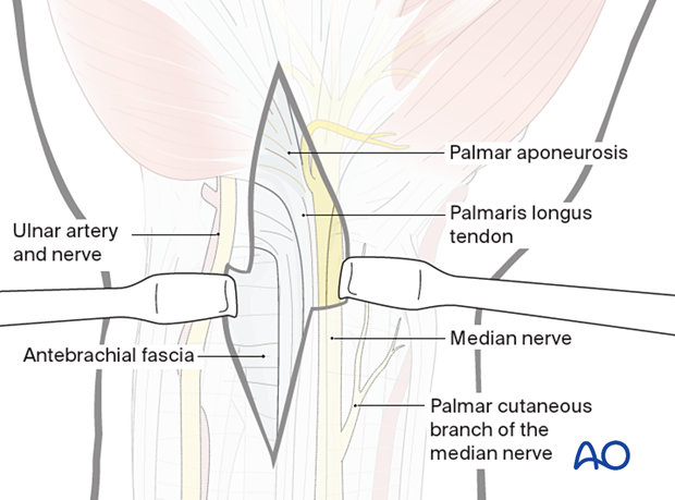 Extended carpal tunnel incision - Elevation of the skin flaps