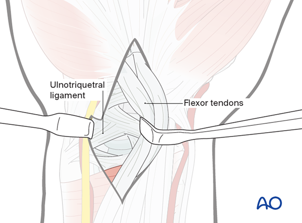 Extended carpal tunnel incision - Retraction of the flexor tendons