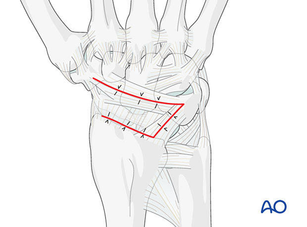 Closing the dorsal capsular incision