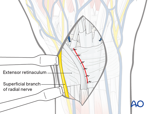 Closing the extensor compartments 