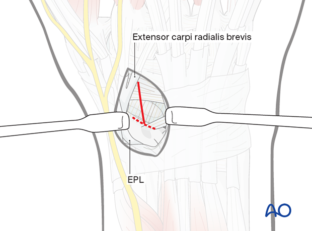 Opening the capsule during dorsal approach to the scaphoid