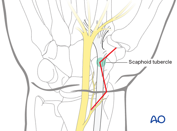 Palmar approach to the scaphoid – Zigzag incision