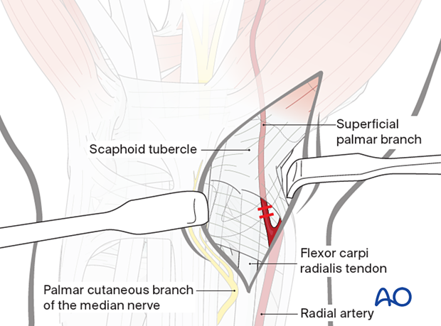 Palmar approach to the scaphoid – Ligation of the palmar branch of radial artery