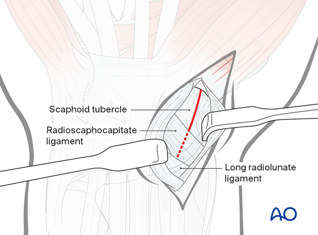 Palmar approach to the scaphoid – Incision