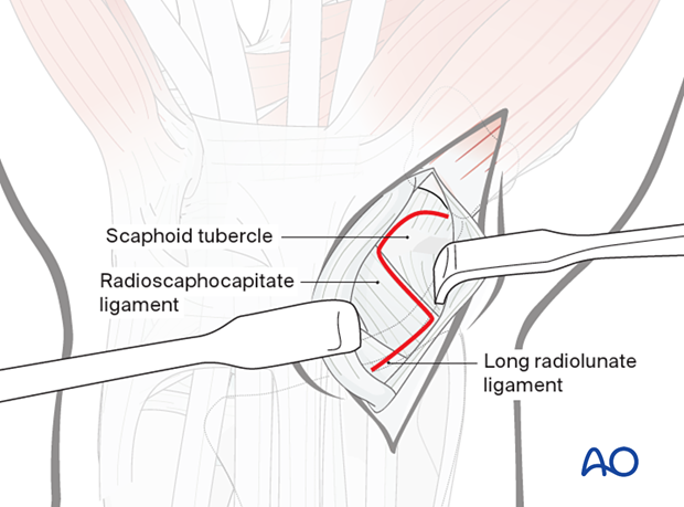 Palmar approach to the scaphoid – Exposure of the wrist capsule with zigzag incision