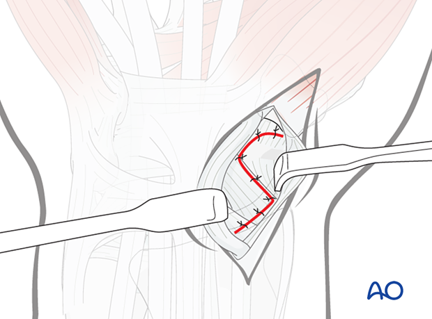 Palmar approach to the scaphoid – Wound closure