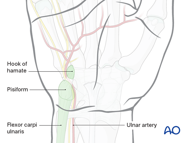 Anatomical landmarks for ulnar approach to the hamate hook