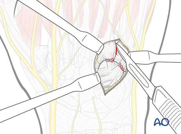 Dorsal approach to the carpometacarpal joints: Capsulotomy