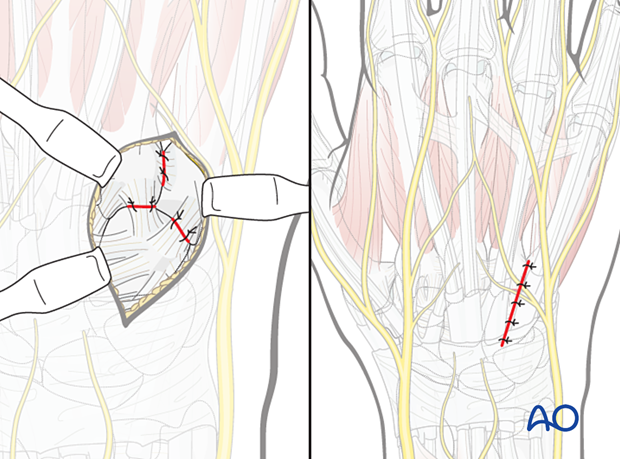 Dorsal approach to the carpometacarpal joints: Wound closure