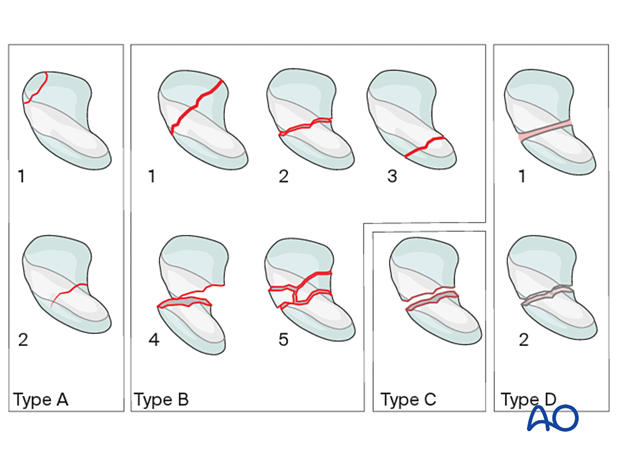 Herbert classification for scaphoid fractures