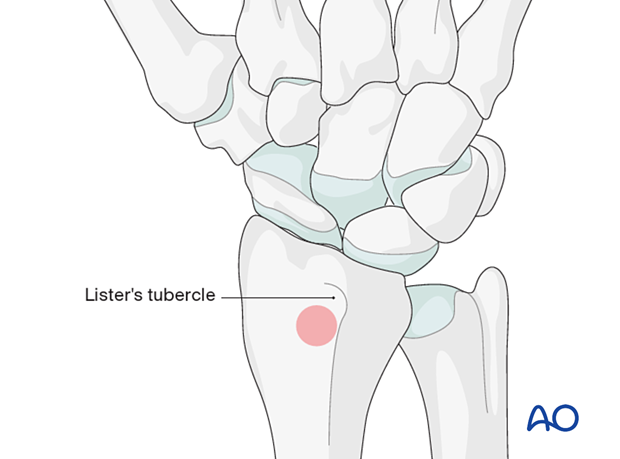 Location of harvest site near Lister’s tubercle for corticocancellous bone